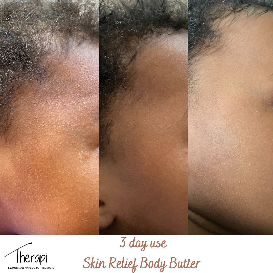 Skin (Eczema) Relief Body Butter