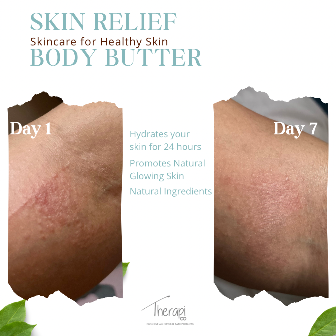 Skin (Eczema) Relief Body Butter